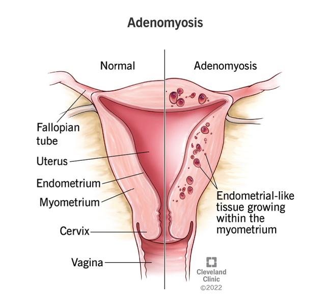 adenomyosis adenomyosis