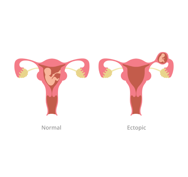 ectopic ectopic