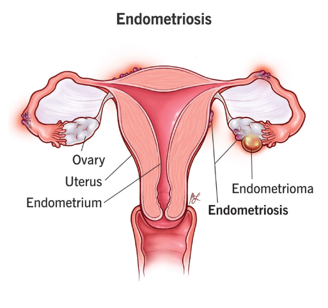 endometriosis endometriosis