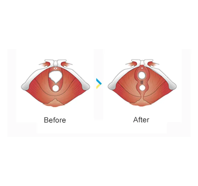 hymenoplasty hymenoplasty