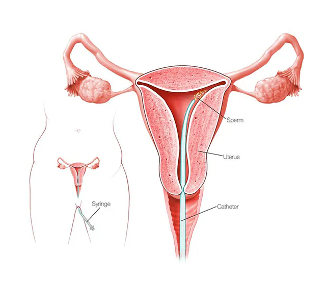 iui iui