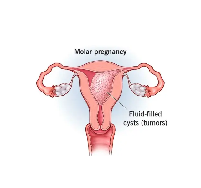 molar pregnancy molar pregnancy