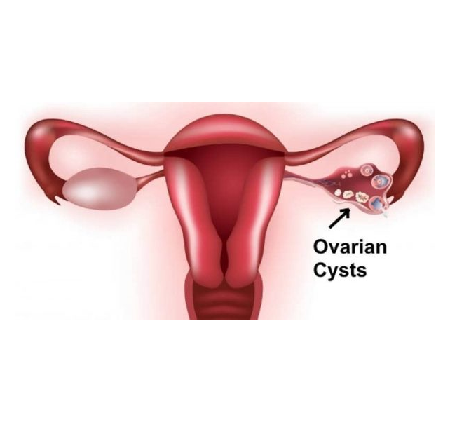 ovarian cysts ovarian cysts
