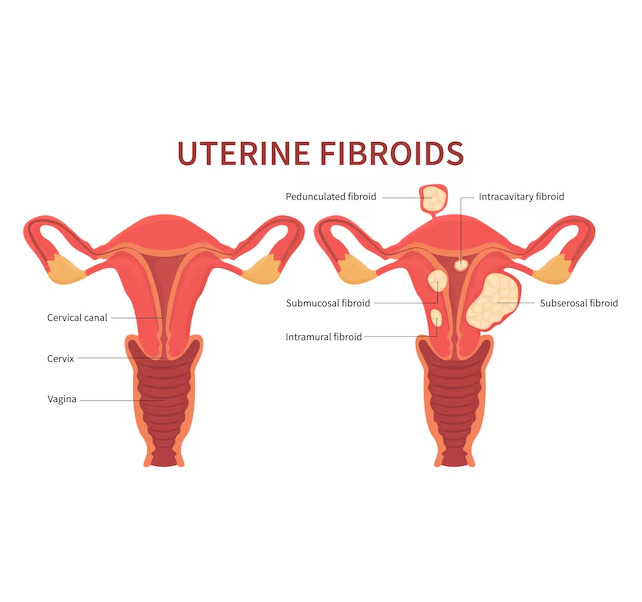 uterine fibroids