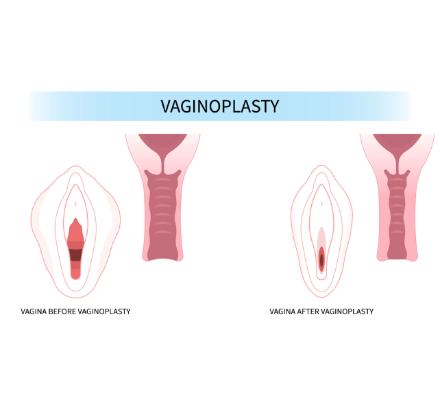 vaginoplasty vaginoplasty